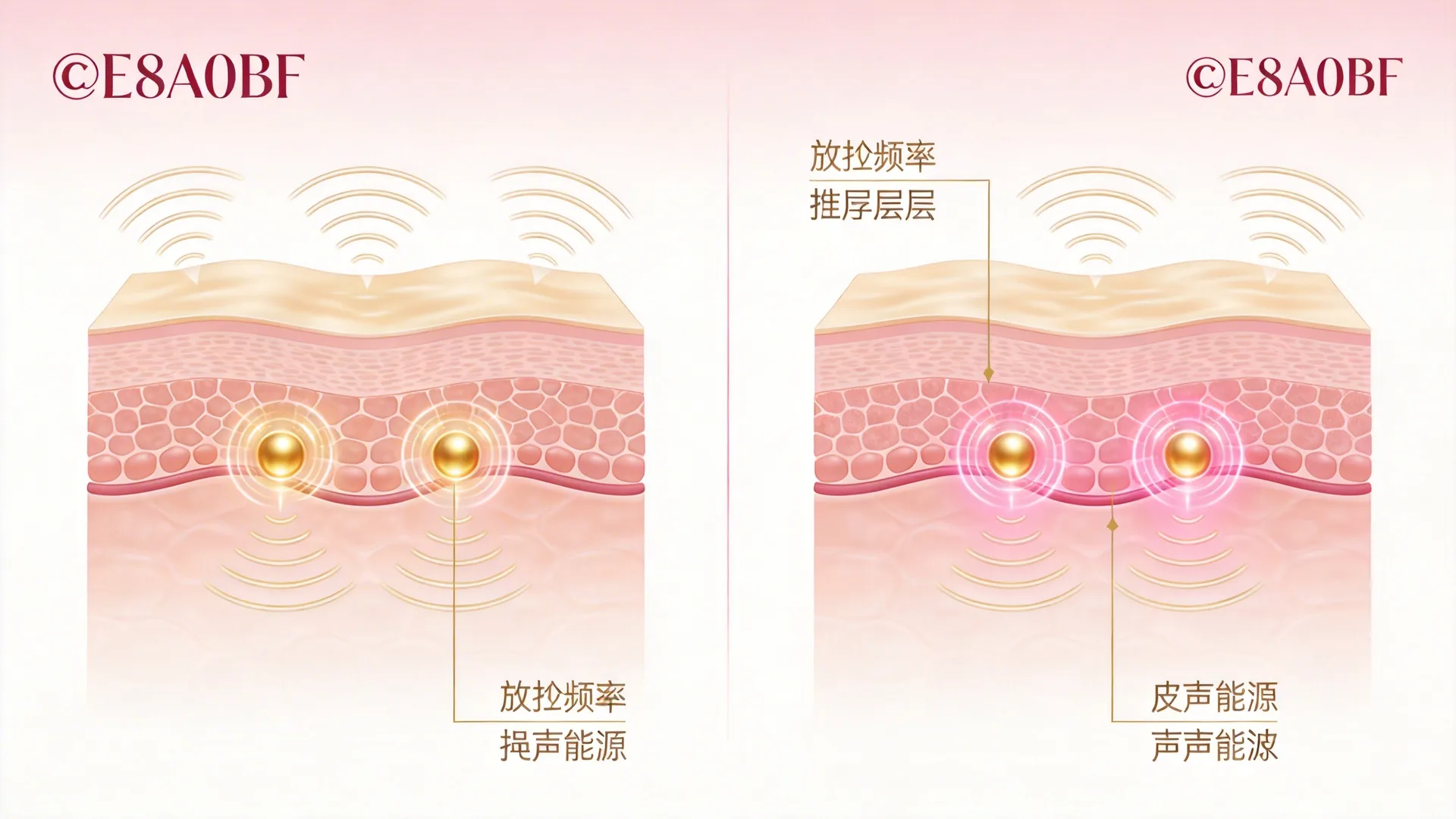 電波與音波作用不同皮膚層次示意圖